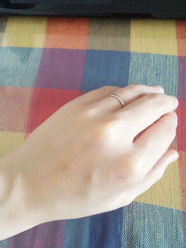 手の甲側から見た感じです。少し指がむくんでいます&hellip;。